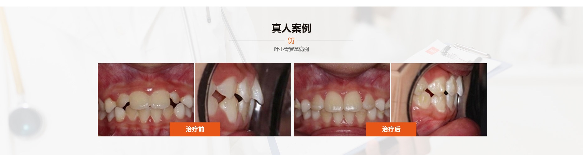 儿童牙案例